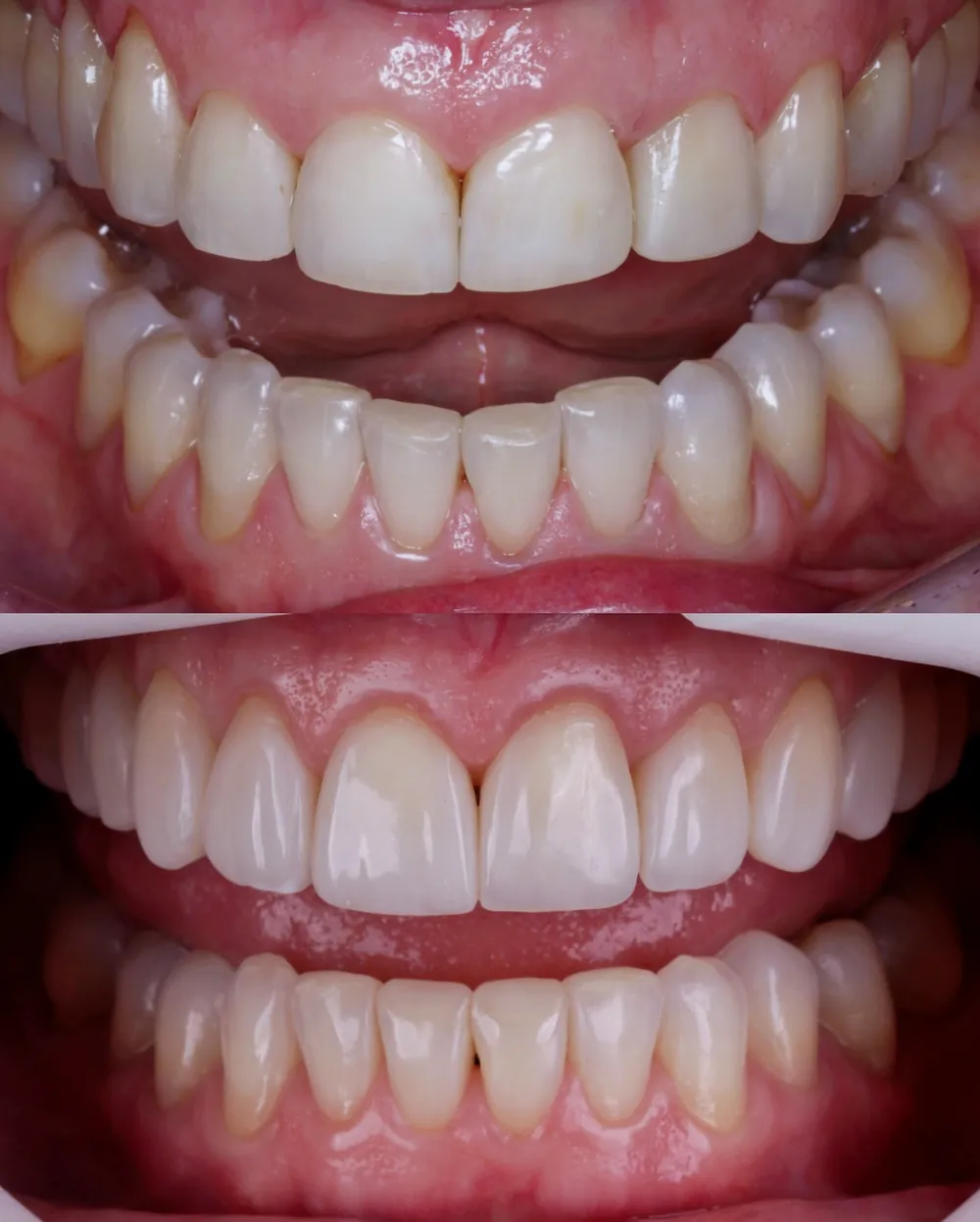 Antes e depois: dentes anteriores restaurados com laminados cerâmicos, vista frontal